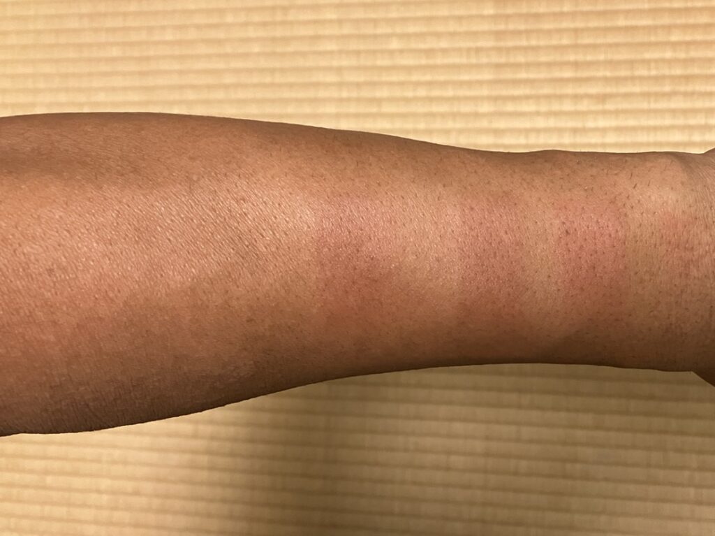 ケノン初回照射の翌朝の左前腕｜試し打ち部分に赤みを確認