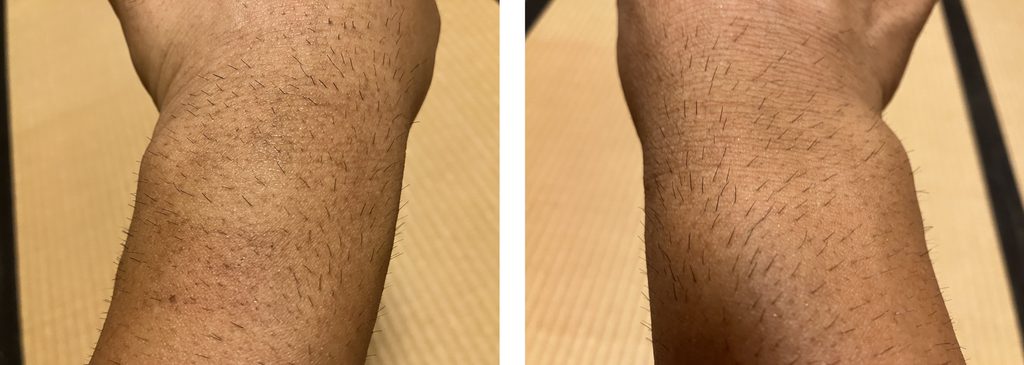 ケノン初回照射から約1週間後の剃毛前の左右前腕比較｜左は照射あり・右は照射なし