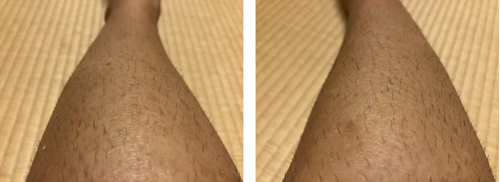 ケノン初回照射から約1週間後の左右の下腿を比較｜左は照射あり・右は照射なし