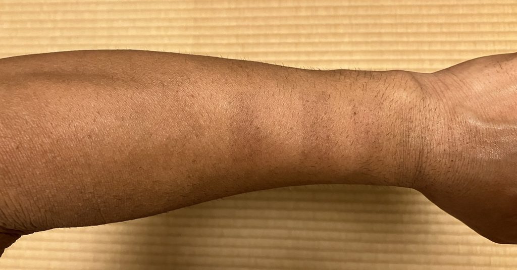 ケノン初回の試し打ちから約1週間後の左前腕
