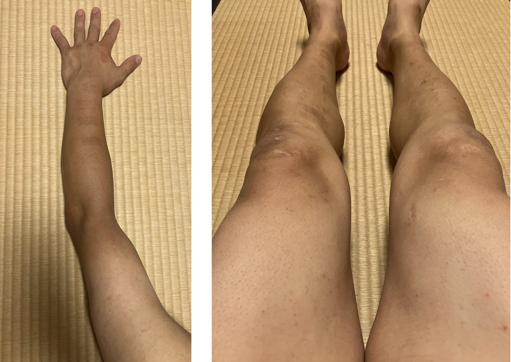 ケノン2回目レベル7照射直後の左腕と両脚の肌の状態