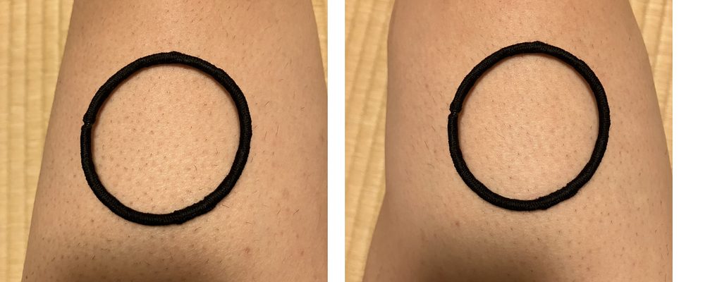 ケノン2回目照射翌日の左右大腿を定点比較｜左大腿は照射あり・右大腿は照射なし