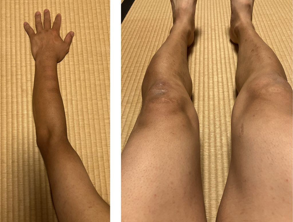 ケノン2回目レベル7照射翌日の左腕と両脚の肌の状態