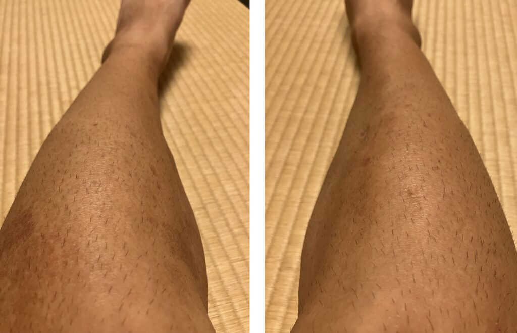 ケノン2回目照射から5日後の剃毛前の左右下腿比較｜左は照射あり・右は照射なし