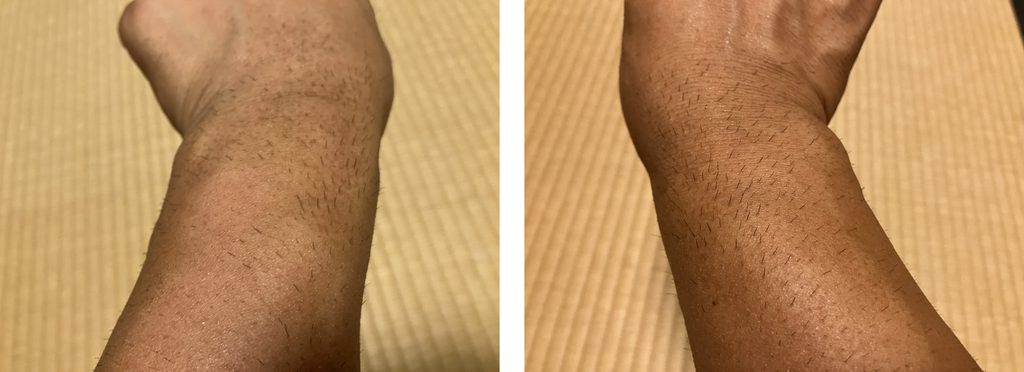 ケノン2回目照射から5日後の剃毛前の左右前腕比較｜手首に近い部分