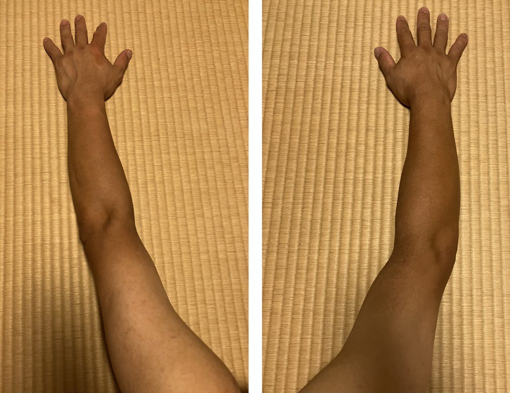 ケノン2回目照射から5日後の剃毛前の左右上肢比較｜左は照射あり・右は照射なし