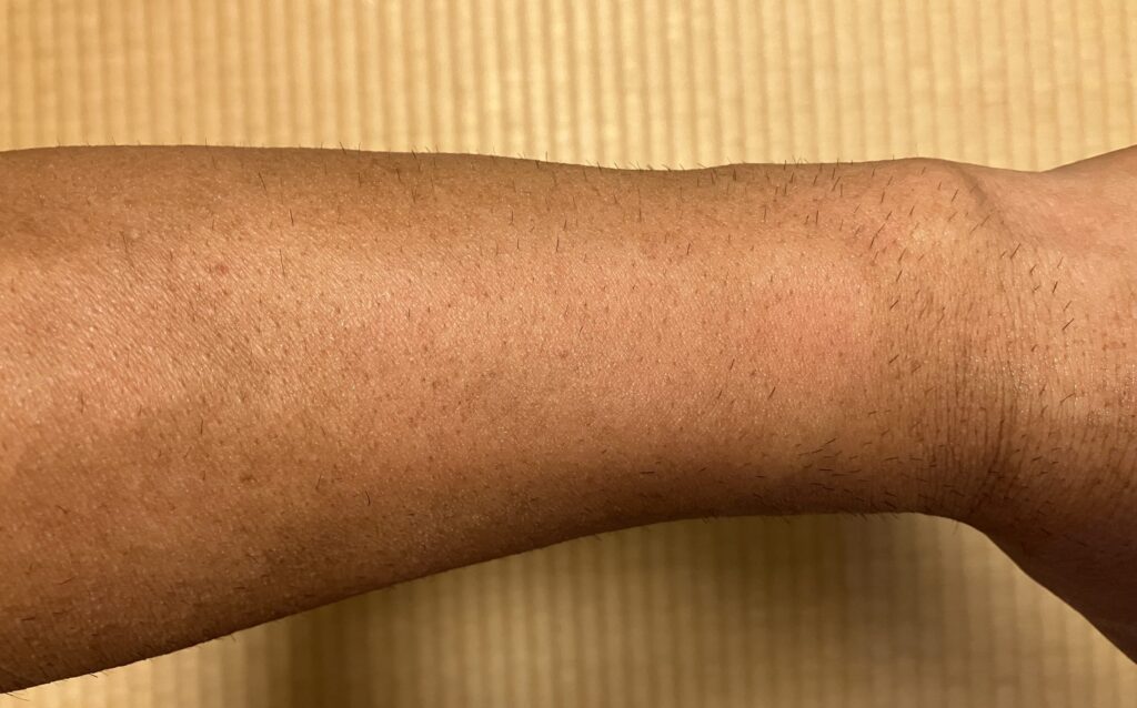 以前周囲より皮膚の色が濃く見えていた左前腕の2026年9月15日の状態