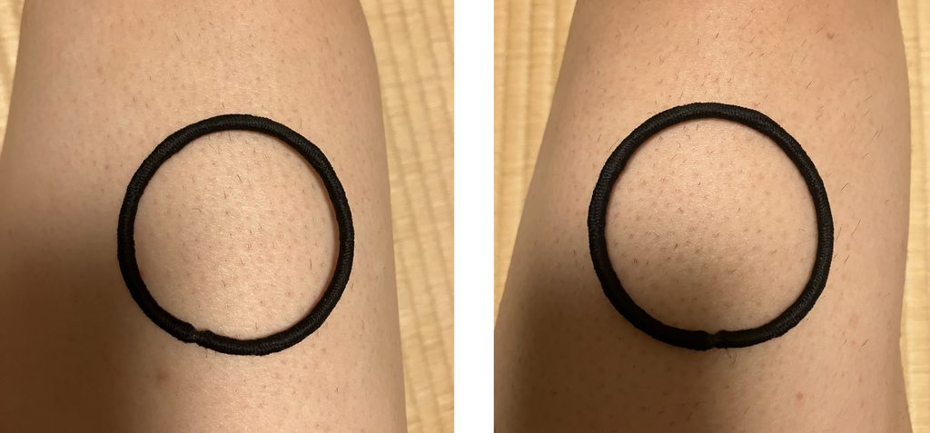 ケノン3回目照射日の左右大腿定点比較｜左大腿は照射あり・右大腿は照射なし