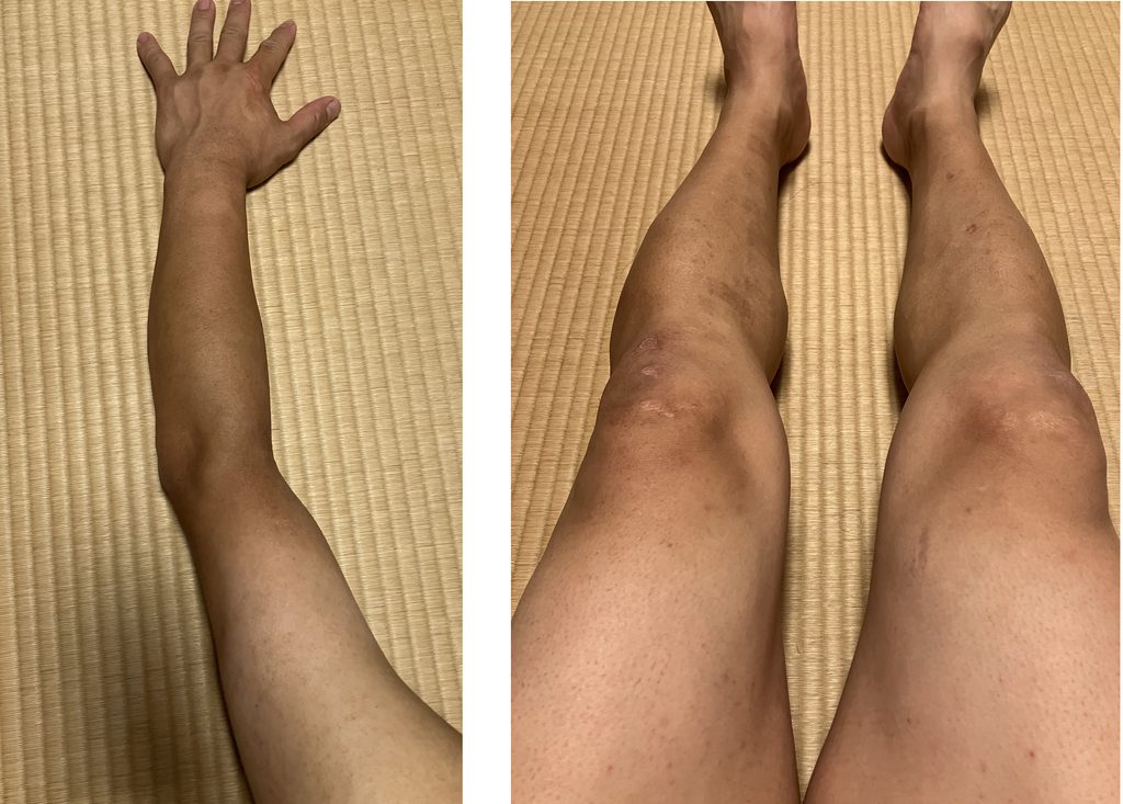 ケノン3回目レベル7照射直後の左腕と両下肢の肌の状態