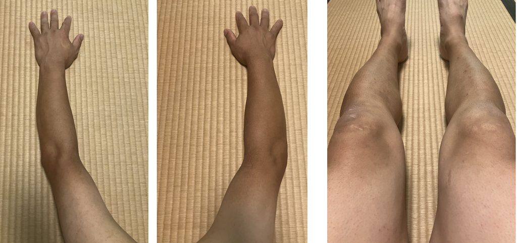 ケノン3回目照射から6日後の剃毛前の両腕・両下肢比較｜左側は照射あり・右側は照射なし