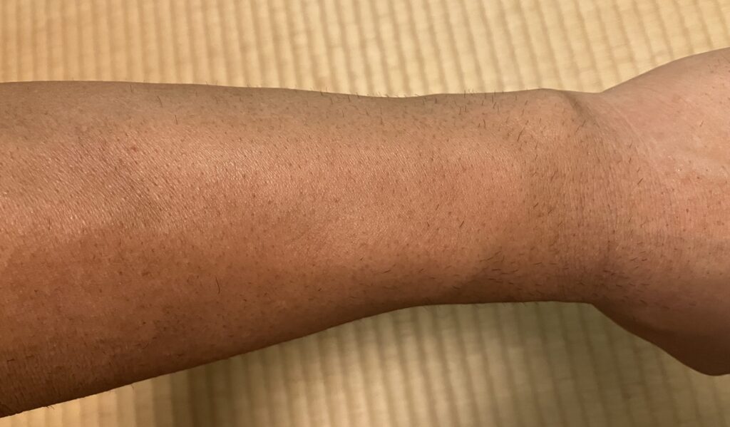 ケノン照射後に色が濃く見えていた左前腕の2026年9月22日の状態