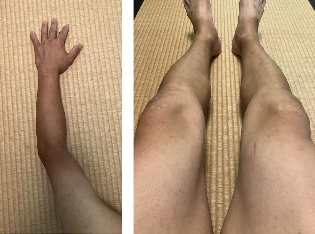 ケノン4回目レベル7照射翌日の左腕と両下肢の肌の状態