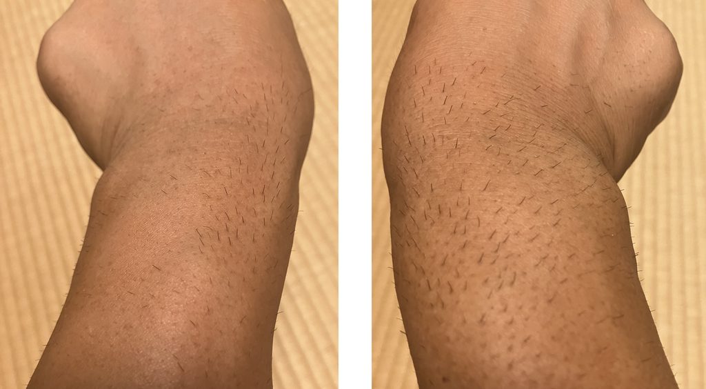ケノン3回目照射から6日後の剃毛前の両前腕比較｜左腕は照射あり・右腕は照射なし
