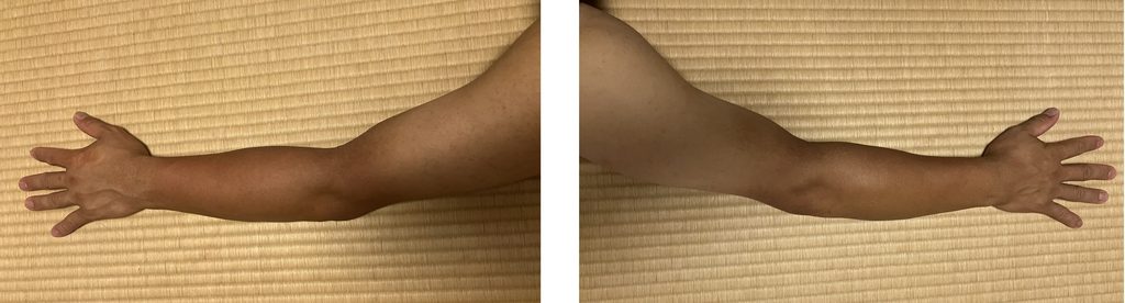 ケノン初回照射後の左右腕比較｜左腕はレベル8で照射・右腕は照射なし