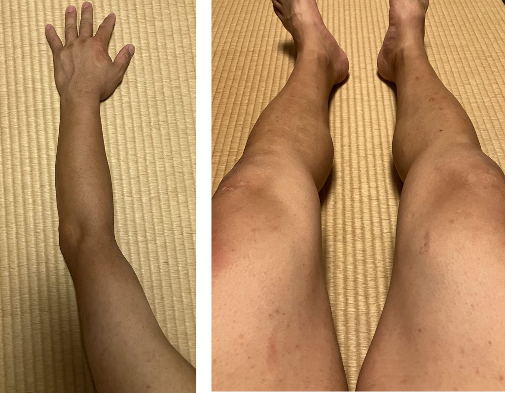 ケノン4回目照射直後の左腕と両下肢