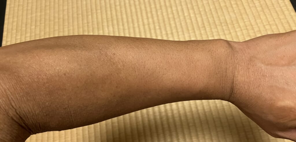 ケノン5回目照射後｜以前色が濃く見えていた左前腕の肌の状態