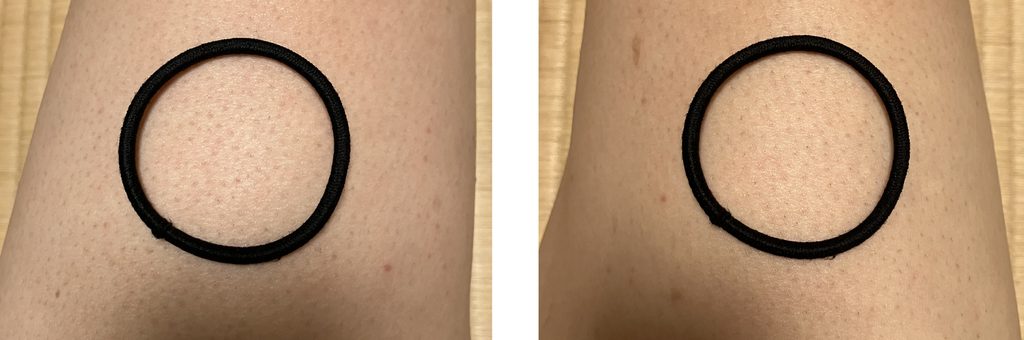 ケノン5回目照射後の大腿定点比較｜左大腿は照射あり・右大腿は照射なし
