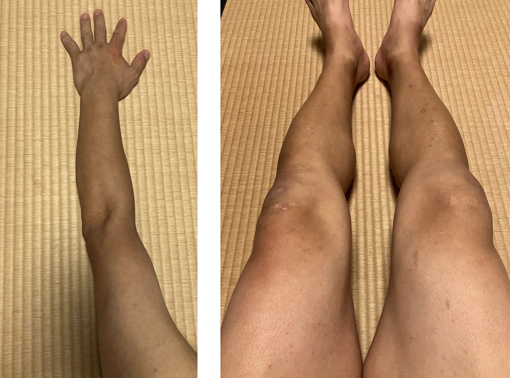 ケノン5回目レベル7照射後の左腕と両下肢｜赤みやヒリつきなし