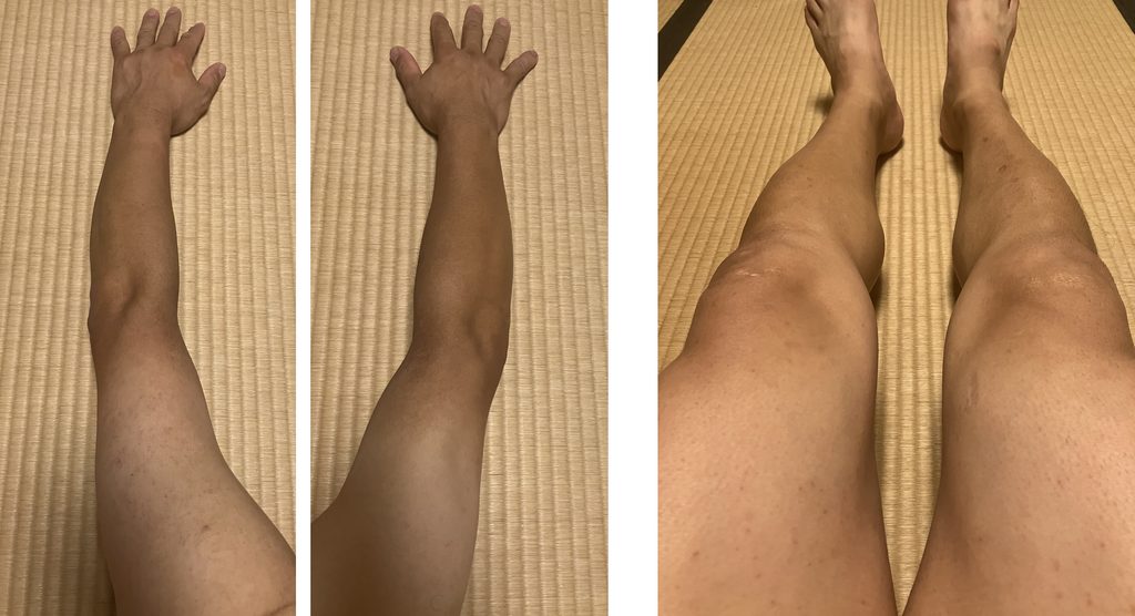 ケノン5回目照射から6日後の剃毛前の腕・脚全体比較｜左腕・左脚は照射あり・右側は照射なし