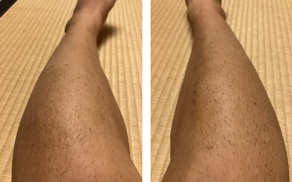 ケノン6回目照射から6日後の剃毛前の両下腿比較｜左下腿は照射あり・右下腿は照射なし