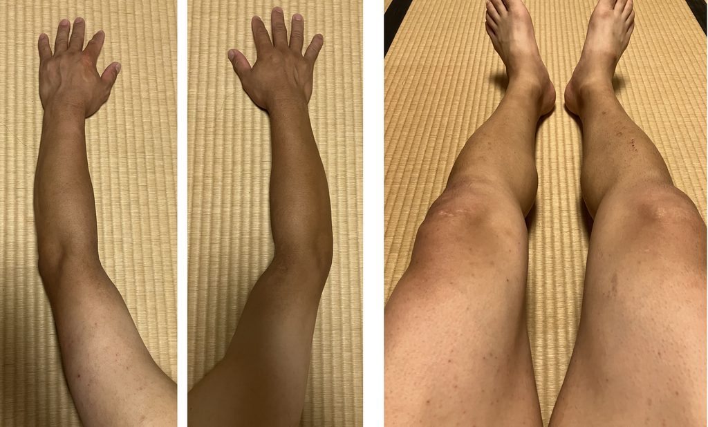 ケノン6回目照射から6日後の剃毛前の両腕・両下肢比較｜左腕・左脚は照射あり、右腕・右脚は照射なし