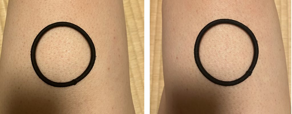 ケノン7回目照射後の左右大腿比較｜左は照射あり・右は照射なし、黒いヘアゴム内の毛を比較
