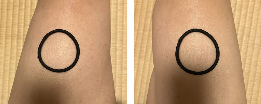 ケノン6回目照射後の左右大腿を黒い輪ゴム内で定点比較｜左は照射あり・右は照射なし