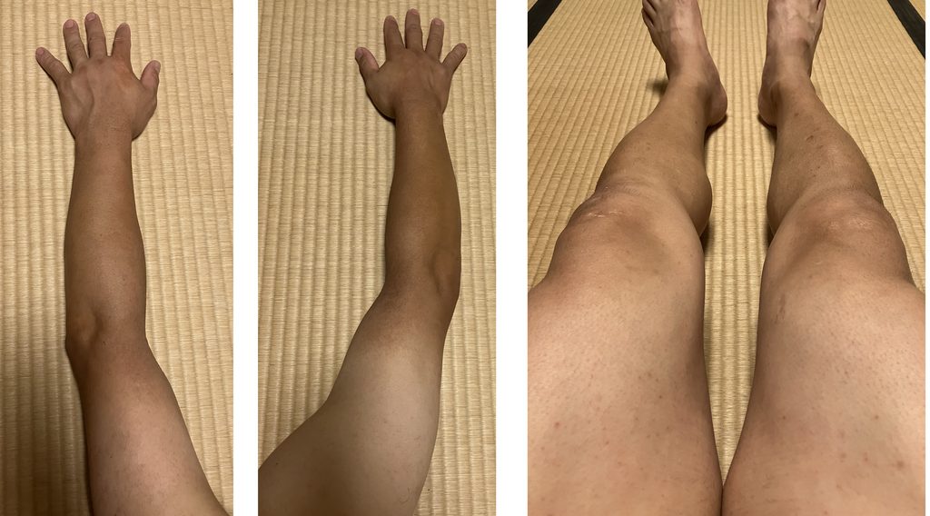 ケノン5回目照射前の両腕・両下肢比較｜左腕・左脚は照射あり・右側は照射なし