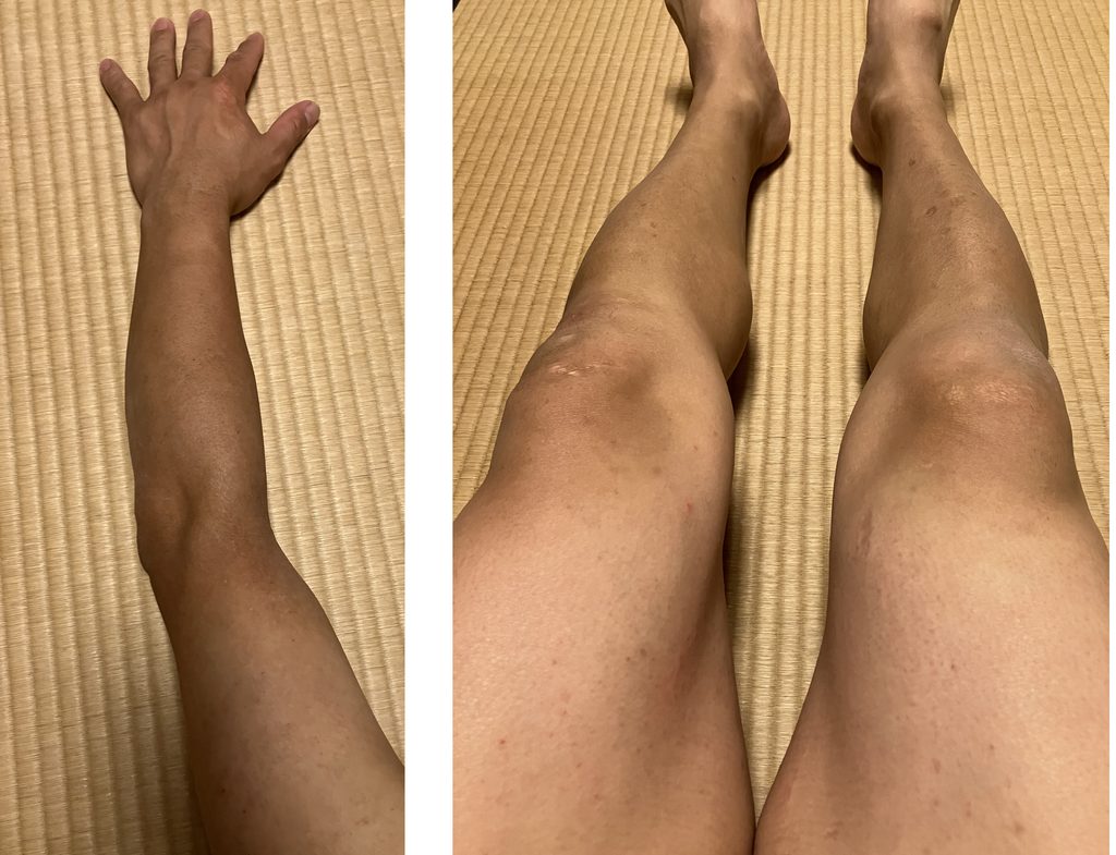 ケノン6回目レベル7照射後の左腕と両下肢｜赤みやヒリつきなし